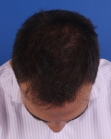 After Hair Transplant&nbsp;Front